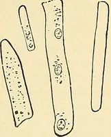 An illustration from An American text-book of genito-urinary diseases, syphilis and diseases of the skin / Ed. by L. Bolton Bangs ... and W. A. Hardaway ... Illustrated with 300 engravings and 20 full-page colored plates. (1898)