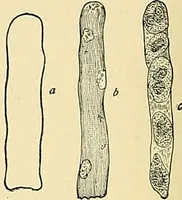 An illustration from An American text-book of genito-urinary diseases, syphilis and diseases of the skin / Ed. by L. Bolton Bangs ... and W. A. Hardaway ... Illustrated with 300 engravings and 20 full-page colored plates. (1898)