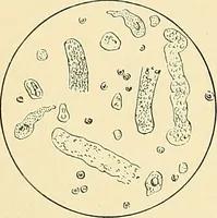 Picture 11 of 146 from An American text-book of genito-urinary diseases, syphilis and diseases of the skin / Ed. by L. Bolton Bangs ... and W. A. Hardaway ... Illustrated with 300 engravings and 20 full-page colored plates. (1898), leaf 46