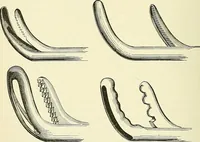 An illustration from An American text-book of genito-urinary diseases, syphilis and diseases of the skin / Ed. by L. Bolton Bangs ... and W. A. Hardaway ... Illustrated with 300 engravings and 20 full-page colored plates. (1898)