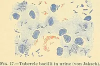 Picture 14 of 146 from An American text-book of genito-urinary diseases, syphilis and diseases of the skin / Ed. by L. Bolton Bangs ... and W. A. Hardaway ... Illustrated with 300 engravings and 20 full-page colored plates. (1898), leaf 49