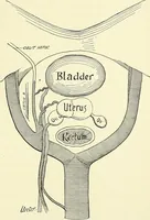 Picture 76 of 146 from An American text-book of genito-urinary diseases, syphilis and diseases of the skin / Ed. by L. Bolton Bangs ... and W. A. Hardaway ... Illustrated with 300 engravings and 20 full-page colored plates. (1898), leaf 491