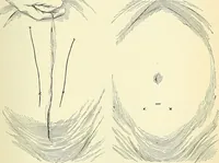 An illustration from An American text-book of genito-urinary diseases, syphilis and diseases of the skin / Ed. by L. Bolton Bangs ... and W. A. Hardaway ... Illustrated with 300 engravings and 20 full-page colored plates. (1898)
