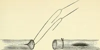 An illustration from An American text-book of genito-urinary diseases, syphilis and diseases of the skin / Ed. by L. Bolton Bangs ... and W. A. Hardaway ... Illustrated with 300 engravings and 20 full-page colored plates. (1898)