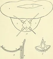 An illustration from An American text-book of genito-urinary diseases, syphilis and diseases of the skin / Ed. by L. Bolton Bangs ... and W. A. Hardaway ... Illustrated with 300 engravings and 20 full-page colored plates. (1898)