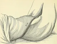 Picture 88 of 146 from An American text-book of genito-urinary diseases, syphilis and diseases of the skin / Ed. by L. Bolton Bangs ... and W. A. Hardaway ... Illustrated with 300 engravings and 20 full-page colored plates. (1898), leaf 532