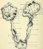 An illustration from An American text-book of genito-urinary diseases, syphilis and diseases of the skin / Ed. by L. Bolton Bangs ... and W. A. Hardaway ... Illustrated with 300 engravings and 20 full-page colored plates. (1898)