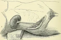 Picture 90 of 146 from An American text-book of genito-urinary diseases, syphilis and diseases of the skin / Ed. by L. Bolton Bangs ... and W. A. Hardaway ... Illustrated with 300 engravings and 20 full-page colored plates. (1898), leaf 548