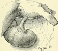 Picture 91 of 146 from An American text-book of genito-urinary diseases, syphilis and diseases of the skin / Ed. by L. Bolton Bangs ... and W. A. Hardaway ... Illustrated with 300 engravings and 20 full-page colored plates. (1898), leaf 549