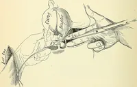 An illustration from An American text-book of genito-urinary diseases, syphilis and diseases of the skin / Ed. by L. Bolton Bangs ... and W. A. Hardaway ... Illustrated with 300 engravings and 20 full-page colored plates. (1898)