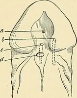 An illustration from An American text-book of genito-urinary diseases, syphilis and diseases of the skin / Ed. by L. Bolton Bangs ... and W. A. Hardaway ... Illustrated with 300 engravings and 20 full-page colored plates. (1898)