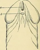 An illustration from An American text-book of genito-urinary diseases, syphilis and diseases of the skin / Ed. by L. Bolton Bangs ... and W. A. Hardaway ... Illustrated with 300 engravings and 20 full-page colored plates. (1898)