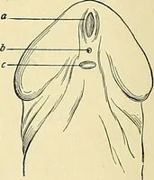 An illustration from An American text-book of genito-urinary diseases, syphilis and diseases of the skin / Ed. by L. Bolton Bangs ... and W. A. Hardaway ... Illustrated with 300 engravings and 20 full-page colored plates. (1898)