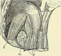 An illustration from An American text-book of genito-urinary diseases, syphilis and diseases of the skin / Ed. by L. Bolton Bangs ... and W. A. Hardaway ... Illustrated with 300 engravings and 20 full-page colored plates. (1898)