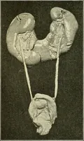 Picture 95 of 146 from An American text-book of genito-urinary diseases, syphilis and diseases of the skin / Ed. by L. Bolton Bangs ... and W. A. Hardaway ... Illustrated with 300 engravings and 20 full-page colored plates. (1898), leaf 564