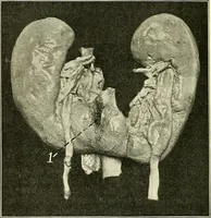 An illustration from An American text-book of genito-urinary diseases, syphilis and diseases of the skin / Ed. by L. Bolton Bangs ... and W. A. Hardaway ... Illustrated with 300 engravings and 20 full-page colored plates. (1898)