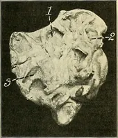 An illustration from An American text-book of genito-urinary diseases, syphilis and diseases of the skin / Ed. by L. Bolton Bangs ... and W. A. Hardaway ... Illustrated with 300 engravings and 20 full-page colored plates. (1898)