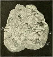An illustration from An American text-book of genito-urinary diseases, syphilis and diseases of the skin / Ed. by L. Bolton Bangs ... and W. A. Hardaway ... Illustrated with 300 engravings and 20 full-page colored plates. (1898)