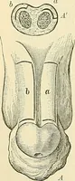 An illustration from An American text-book of genito-urinary diseases, syphilis and diseases of the skin / Ed. by L. Bolton Bangs ... and W. A. Hardaway ... Illustrated with 300 engravings and 20 full-page colored plates. (1898)