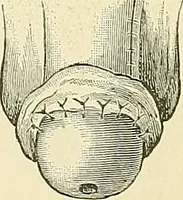 An illustration from An American text-book of genito-urinary diseases, syphilis and diseases of the skin / Ed. by L. Bolton Bangs ... and W. A. Hardaway ... Illustrated with 300 engravings and 20 full-page colored plates. (1898)