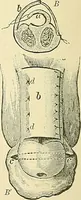 An illustration from An American text-book of genito-urinary diseases, syphilis and diseases of the skin / Ed. by L. Bolton Bangs ... and W. A. Hardaway ... Illustrated with 300 engravings and 20 full-page colored plates. (1898)