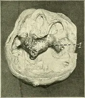 Picture 101 of 146 from An American text-book of genito-urinary diseases, syphilis and diseases of the skin / Ed. by L. Bolton Bangs ... and W. A. Hardaway ... Illustrated with 300 engravings and 20 full-page colored plates. (1898), leaf 581