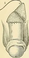 An illustration from An American text-book of genito-urinary diseases, syphilis and diseases of the skin / Ed. by L. Bolton Bangs ... and W. A. Hardaway ... Illustrated with 300 engravings and 20 full-page colored plates. (1898)