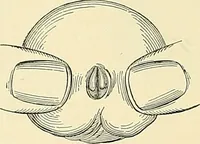An illustration from An American text-book of genito-urinary diseases, syphilis and diseases of the skin / Ed. by L. Bolton Bangs ... and W. A. Hardaway ... Illustrated with 300 engravings and 20 full-page colored plates. (1898)