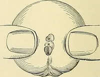 An illustration from An American text-book of genito-urinary diseases, syphilis and diseases of the skin / Ed. by L. Bolton Bangs ... and W. A. Hardaway ... Illustrated with 300 engravings and 20 full-page colored plates. (1898)