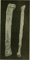 An illustration from An American text-book of genito-urinary diseases, syphilis and diseases of the skin / Ed. by L. Bolton Bangs ... and W. A. Hardaway ... Illustrated with 300 engravings and 20 full-page colored plates. (1898)