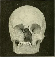 An illustration from An American text-book of genito-urinary diseases, syphilis and diseases of the skin / Ed. by L. Bolton Bangs ... and W. A. Hardaway ... Illustrated with 300 engravings and 20 full-page colored plates. (1898)