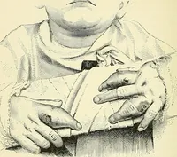 An illustration from An American text-book of genito-urinary diseases, syphilis and diseases of the skin / Ed. by L. Bolton Bangs ... and W. A. Hardaway ... Illustrated with 300 engravings and 20 full-page colored plates. (1898)