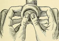 An illustration from An American text-book of genito-urinary diseases, syphilis and diseases of the skin / Ed. by L. Bolton Bangs ... and W. A. Hardaway ... Illustrated with 300 engravings and 20 full-page colored plates. (1898)