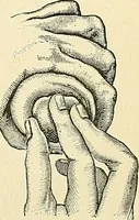 An illustration from An American text-book of genito-urinary diseases, syphilis and diseases of the skin / Ed. by L. Bolton Bangs ... and W. A. Hardaway ... Illustrated with 300 engravings and 20 full-page colored plates. (1898)
