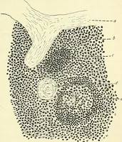 An illustration from An American text-book of genito-urinary diseases, syphilis and diseases of the skin / Ed. by L. Bolton Bangs ... and W. A. Hardaway ... Illustrated with 300 engravings and 20 full-page colored plates. (1898)