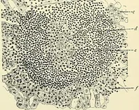 An illustration from An American text-book of genito-urinary diseases, syphilis and diseases of the skin / Ed. by L. Bolton Bangs ... and W. A. Hardaway ... Illustrated with 300 engravings and 20 full-page colored plates. (1898)