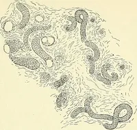An illustration from An American text-book of genito-urinary diseases, syphilis and diseases of the skin / Ed. by L. Bolton Bangs ... and W. A. Hardaway ... Illustrated with 300 engravings and 20 full-page colored plates. (1898)