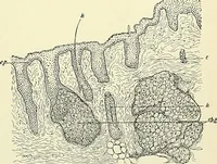 An illustration from An American text-book of genito-urinary diseases, syphilis and diseases of the skin / Ed. by L. Bolton Bangs ... and W. A. Hardaway ... Illustrated with 300 engravings and 20 full-page colored plates. (1898)