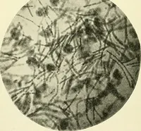 An illustration from An American text-book of genito-urinary diseases, syphilis and diseases of the skin / Ed. by L. Bolton Bangs ... and W. A. Hardaway ... Illustrated with 300 engravings and 20 full-page colored plates. (1898)