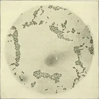An illustration from An American text-book of genito-urinary diseases, syphilis and diseases of the skin / Ed. by L. Bolton Bangs ... and W. A. Hardaway ... Illustrated with 300 engravings and 20 full-page colored plates. (1898)