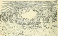 An illustration from An American text-book of genito-urinary diseases, syphilis and diseases of the skin / Ed. by L. Bolton Bangs ... and W. A. Hardaway ... Illustrated with 300 engravings and 20 full-page colored plates. (1898)