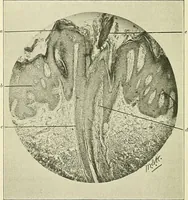Picture 121 of 146 from An American text-book of genito-urinary diseases, syphilis and diseases of the skin / Ed. by L. Bolton Bangs ... and W. A. Hardaway ... Illustrated with 300 engravings and 20 full-page colored plates. (1898), leaf 954