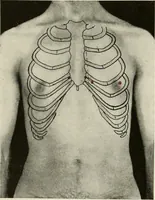 Picture 10 of 52 from Diseases of the heart and arterial system : designed to be a practical presentation of the subject for the use of students and practitioners of medicine / by Robert H. Babcock ... with three coloured plates and one hundred and thirty-nine illustrations. (1903), leaf 126