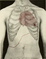 An illustration from Diseases of the heart and arterial system : designed to be a practical presentation of the subject for the use of students and practitioners of medicine / by Robert H. Babcock ... with three coloured plates and one hundred and thirty-nine illustrations. (1903)