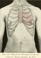 An illustration from Diseases of the heart and arterial system : designed to be a practical presentation of the subject for the use of students and practitioners of medicine / by Robert H. Babcock ... with three coloured plates and one hundred and thirty-nine illustrations. (1903)