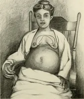 Picture 15 of 52 from Diseases of the heart and arterial system : designed to be a practical presentation of the subject for the use of students and practitioners of medicine / by Robert H. Babcock ... with three coloured plates and one hundred and thirty-nine illustrations. (1903), leaf 290