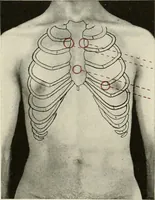 Picture 2 of 52 from Diseases of the heart and arterial system : designed to be a practical presentation of the subject for the use of students and practitioners of medicine / by Robert H. Babcock ... with three coloured plates and one hundred and thirty-nine illustrations. (1903), leaf 36