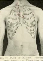 An illustration from Diseases of the heart and arterial system : designed to be a practical presentation of the subject for the use of students and practitioners of medicine / by Robert H. Babcock ... with three coloured plates and one hundred and thirty-nine illustrations. (1903)