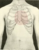 An illustration from Diseases of the heart and arterial system : designed to be a practical presentation of the subject for the use of students and practitioners of medicine / by Robert H. Babcock ... with three coloured plates and one hundred and thirty-nine illustrations. (1903)
