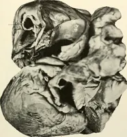 An illustration from Diseases of the heart and arterial system : designed to be a practical presentation of the subject for the use of students and practitioners of medicine / by Robert H. Babcock ... with three coloured plates and one hundred and thirty-nine illustrations. (1903)
